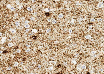 Alzheimer’s Research Going Back To Basics For Brain Clues : Shots